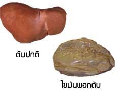 ไขมันพอกตับ