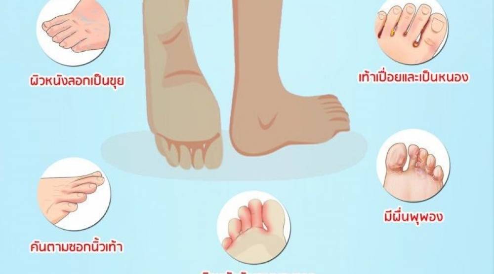 น้ำกัดเท้า รักษาอย่างไร เรามีคำตอบ